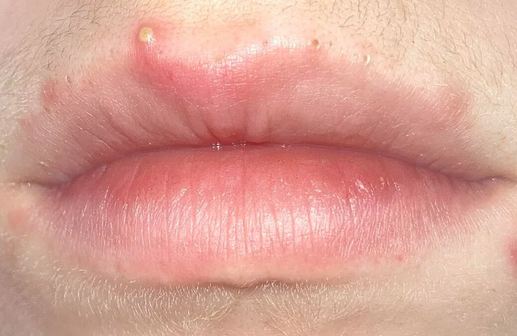 muncul jerawat diatas bibir